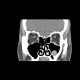 Dentigenous cyst in maxillary sinus: CT - Computed tomography